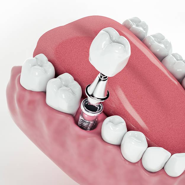 dentalimplant