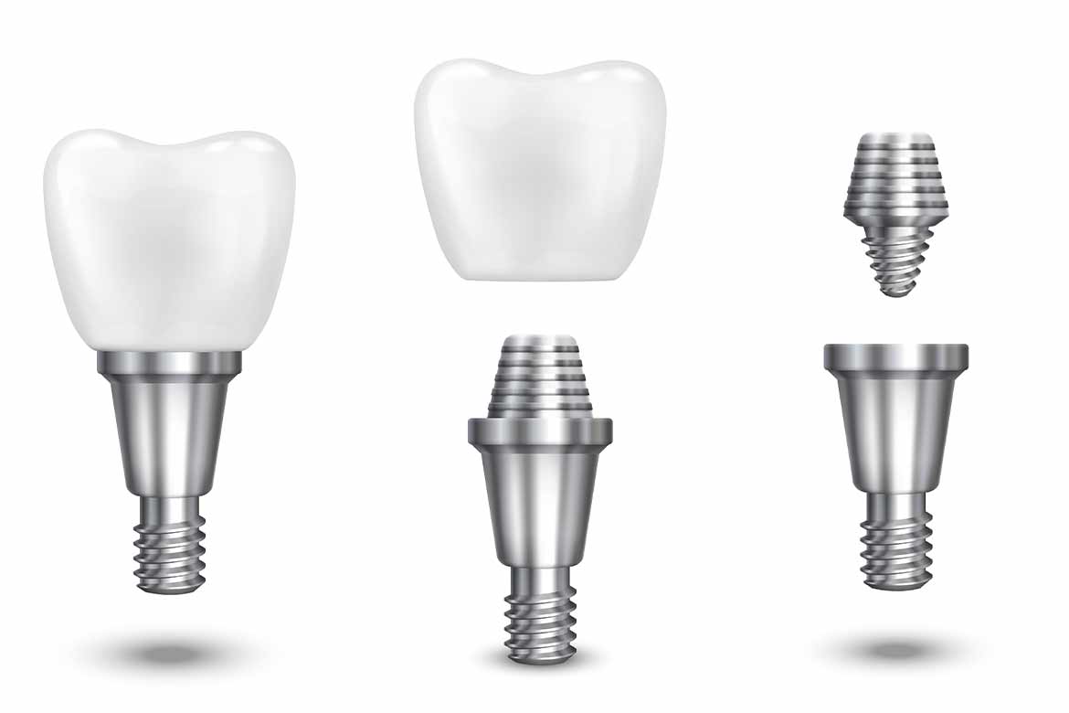 dentalimplant